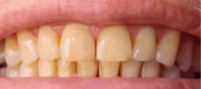 A close up of a person's mouth with stained teeth.