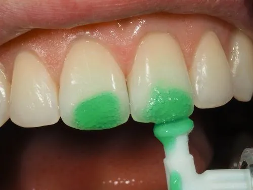 A close up of a person's teeth with green gel.