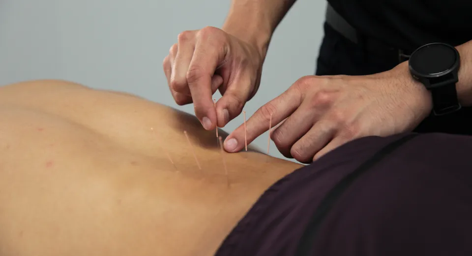 dry needling services in Lansvale NSW