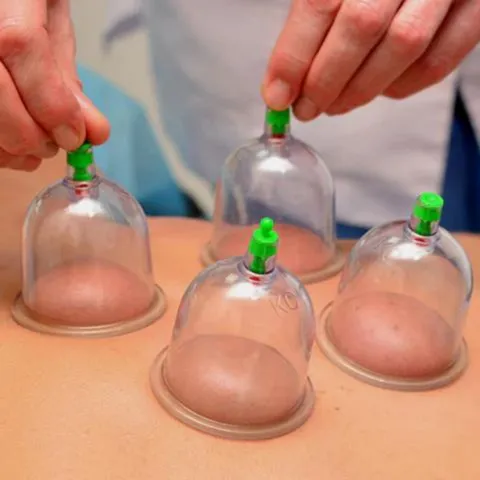 Dry cupping therapy