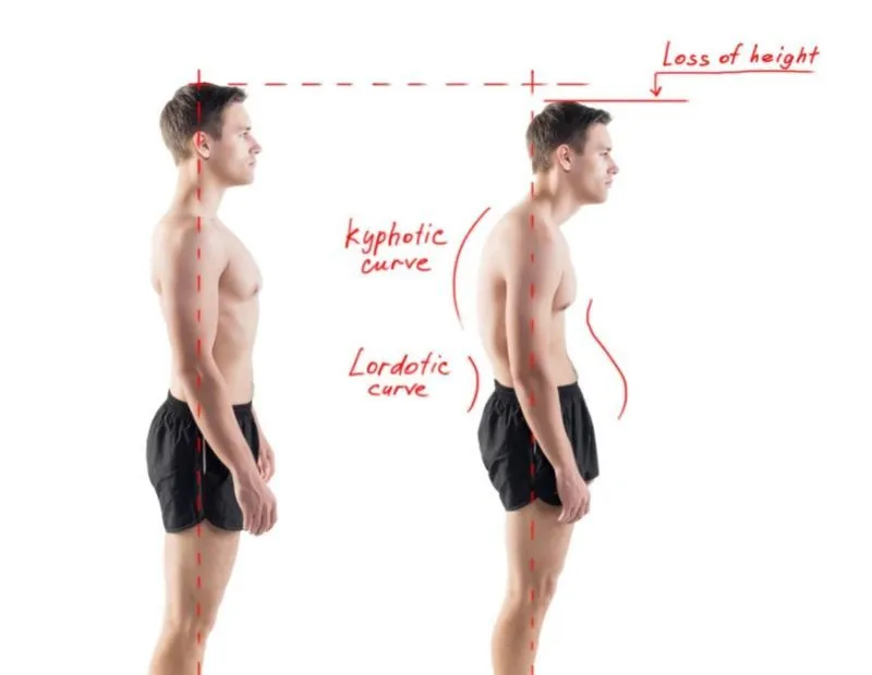 Incorporating postural assessment into chiropractic consultations