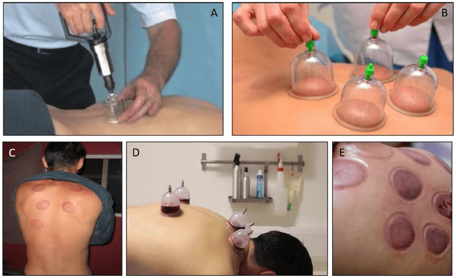 Cupping therapy in sports medicine research