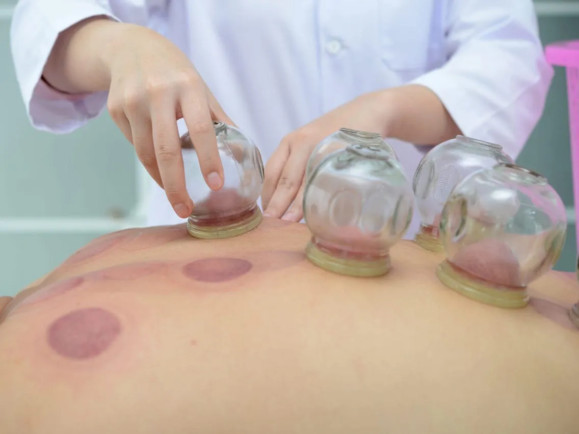 Cupping therapy session