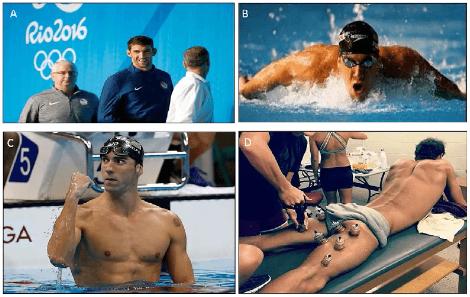 Cupping therapy for athletes performance enhancement