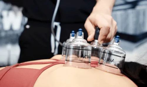 Cupping therapy in modern medicine