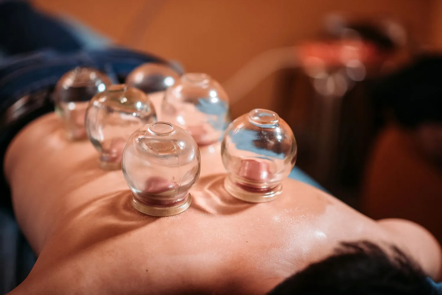 Cupping therapy traditional practices