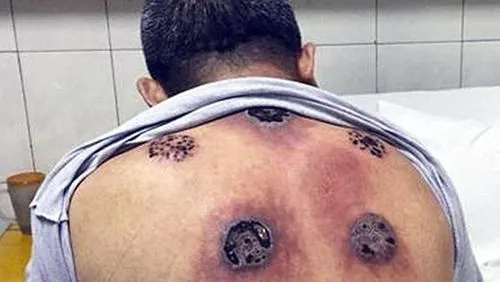Real-life stories of cupping therapy