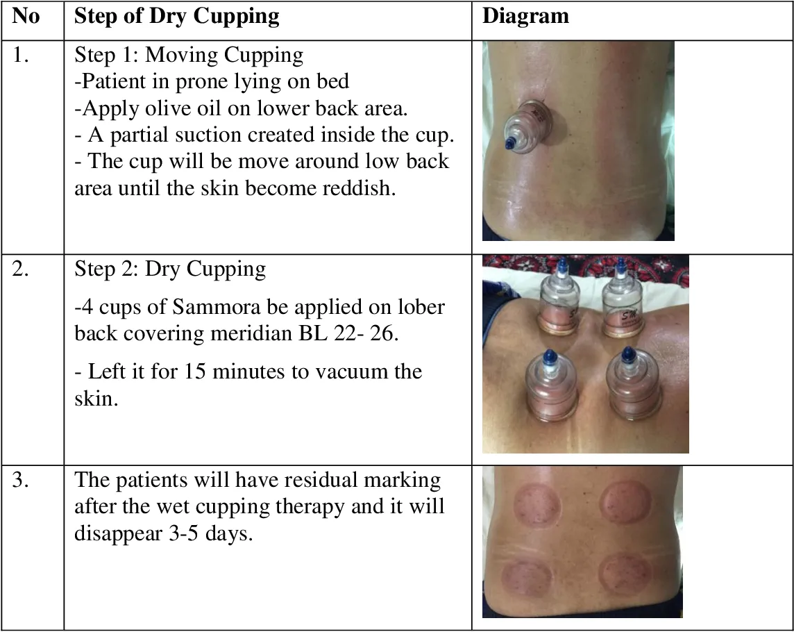 effectiveness of cupping therapy for back pain