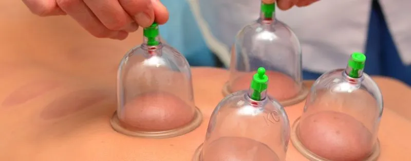 Reputable cupping therapy clinic