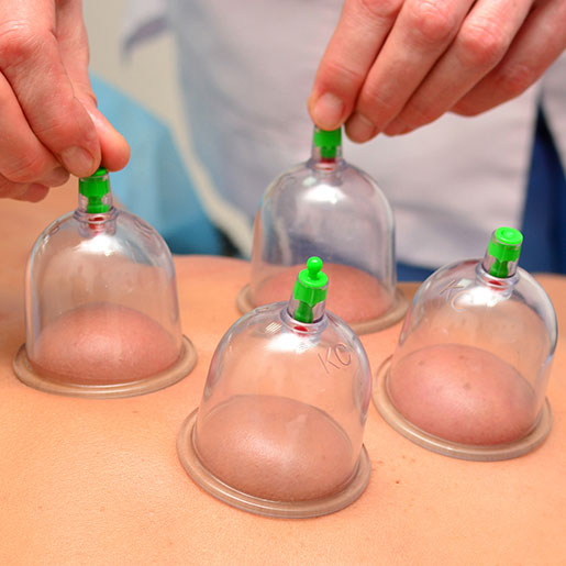 Cupping therapy traditional practice