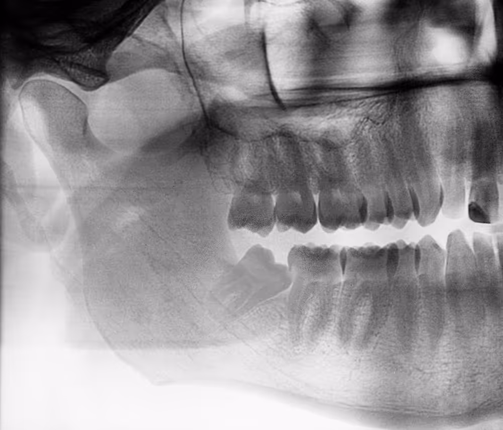 OPG with impacted wisdom tooth