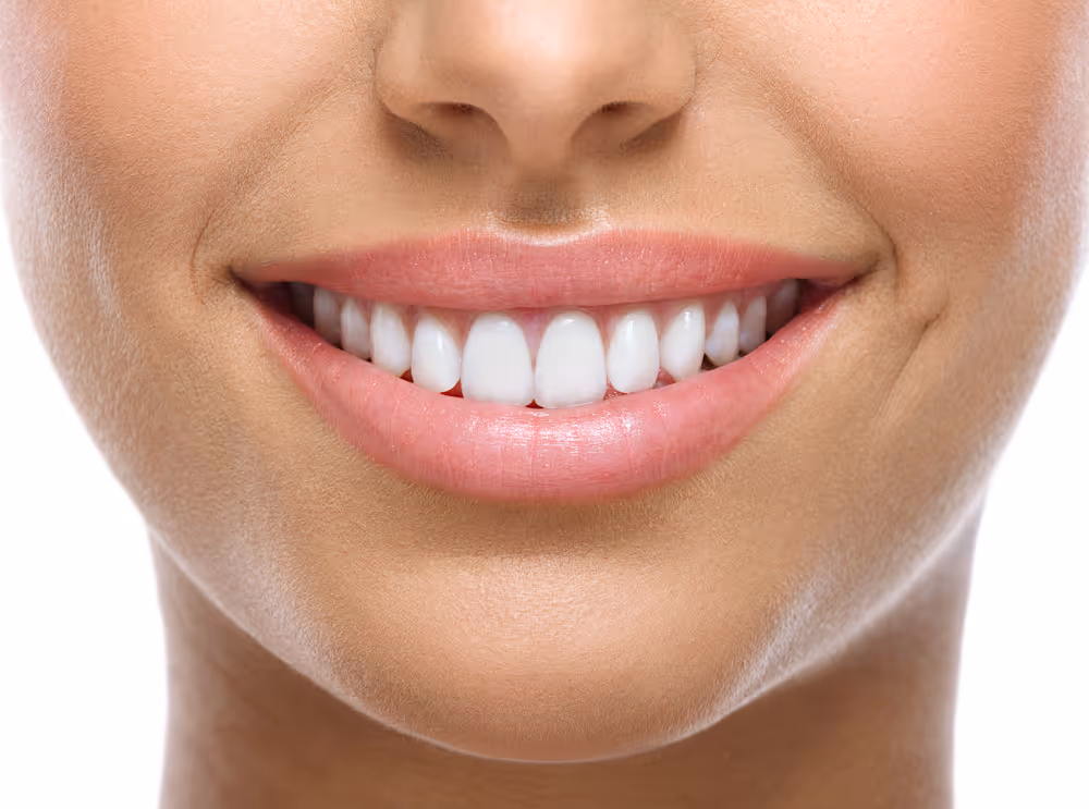 Dental Veneers