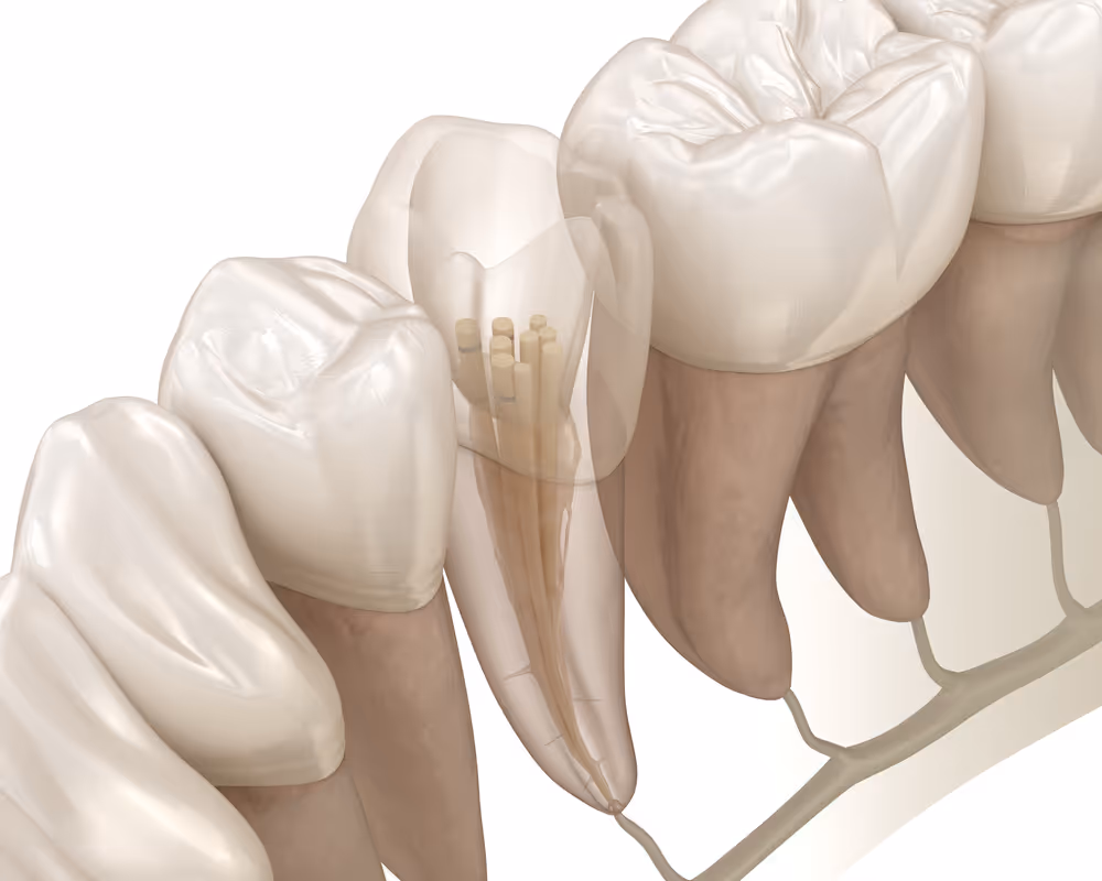 Root Canal Treatment