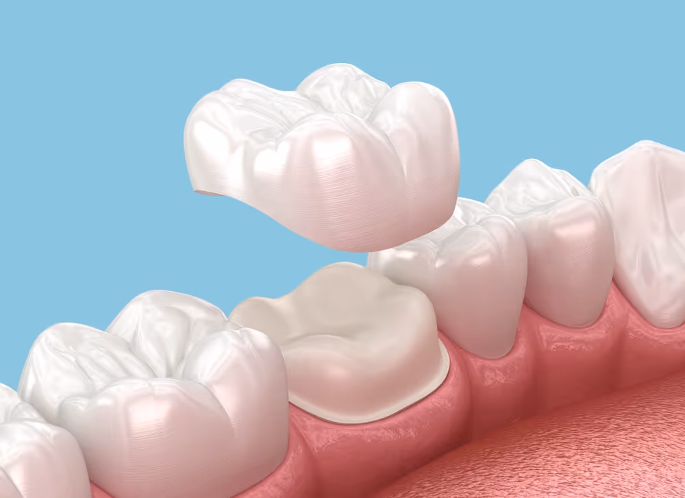 Ceramic Crowns