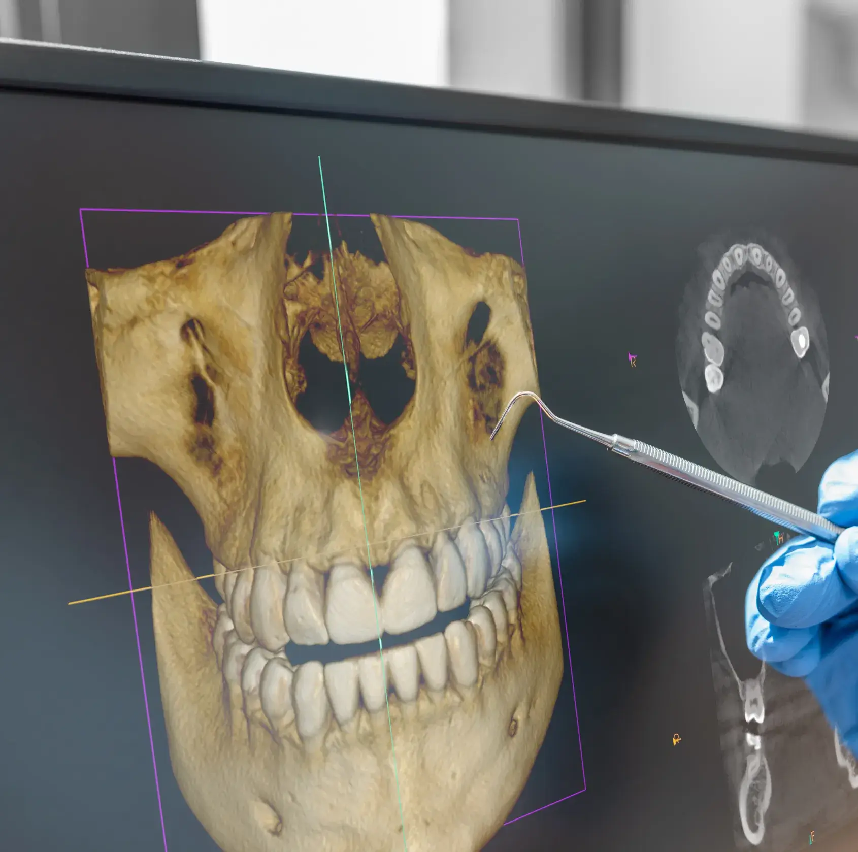 A person in blue gloves is looking at an x - ray of a skull.