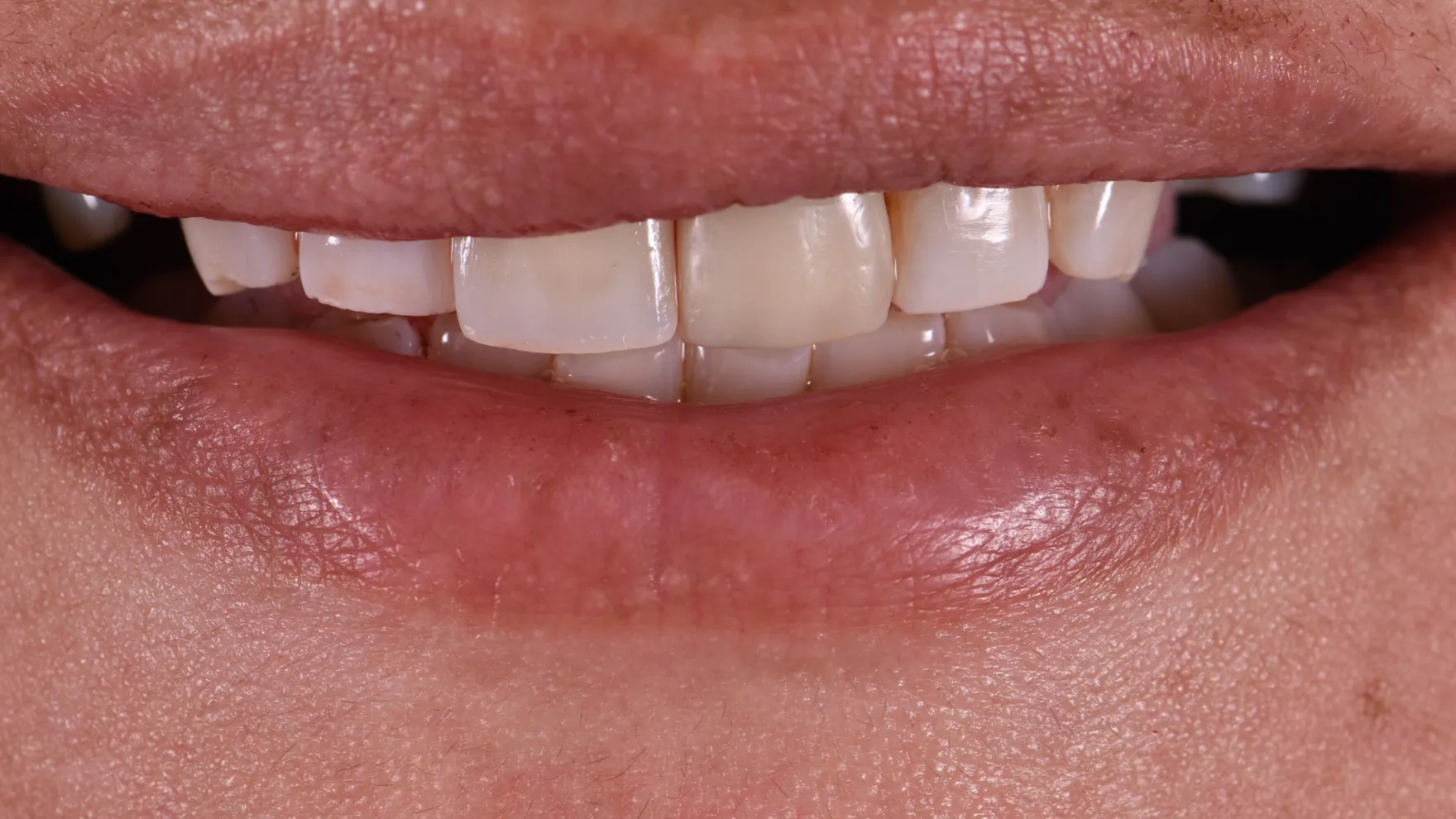 Treatment After