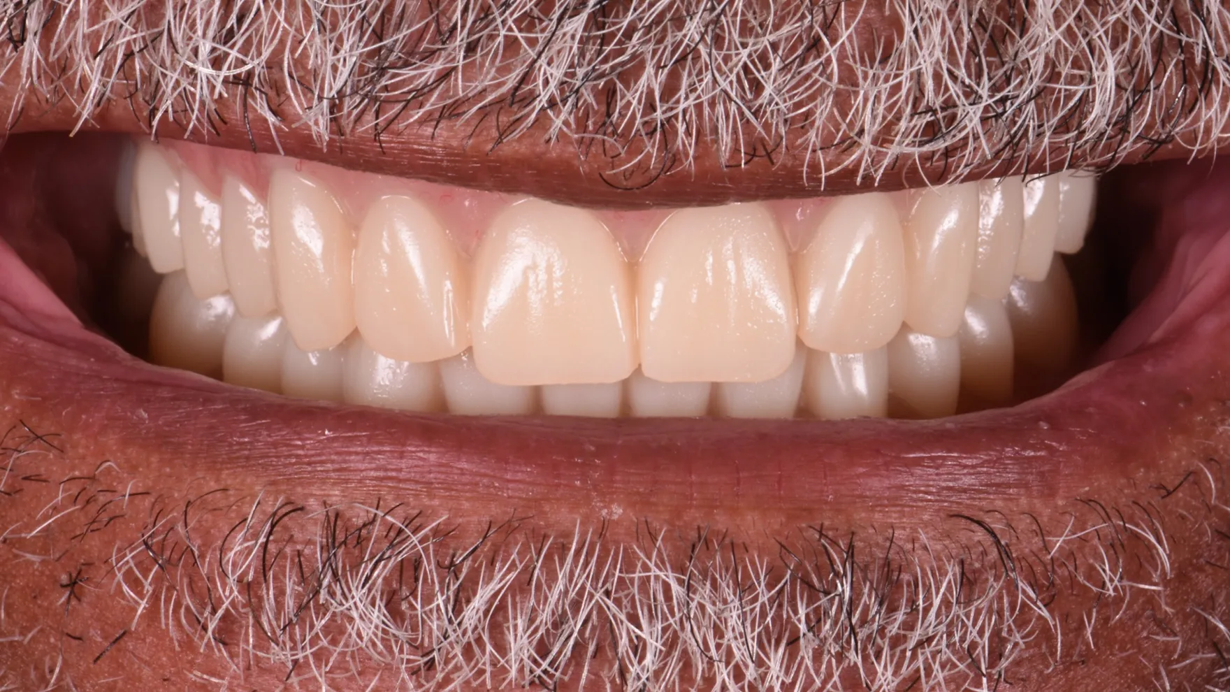 Treatment After