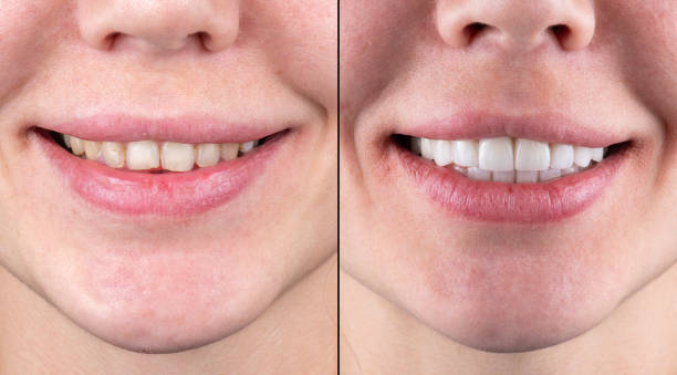 ceramic crowns and veneers before and after picture ceramic crowns and veneers before and after picture veneers before and after stock pictures, royalty-free photos & images