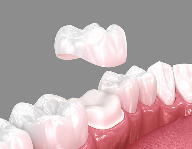 Dental crown placement over tooth. 3D illustration Dental crown placement over tooth. 3D illustration dental crown prep stock pictures, royalty-free photos & images