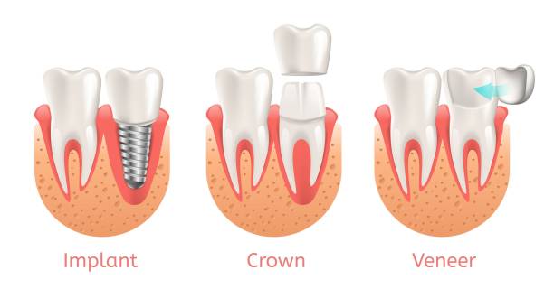 Teeth Procedure Implant Veneer Crown Restoration Teeth Procedure of Implant Veneer Crown Restoration. Vector Illustration Poster with Process Stomatology Prosthesis. 3d Realistic dental Banner. veneers vs crowns stock illustrations