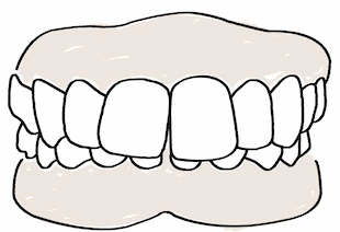 Représentation graphique d'une malocclusion mineure