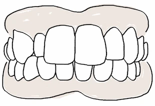 Représentation graphique d'une malocclusion prononcé