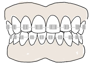 Représentation graphique de bagues orthodontiques