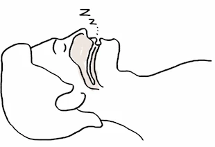 Représentation graphique d'une apnée du sommeil