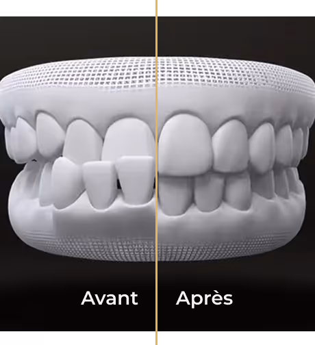 Représentation 3D d'un avant-après traitement orthodontique