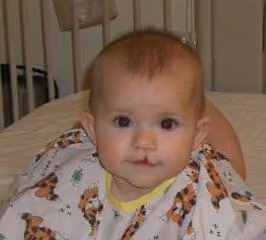 cleft lip, cleft palate
