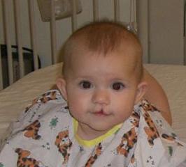cleft lip, cleft palate