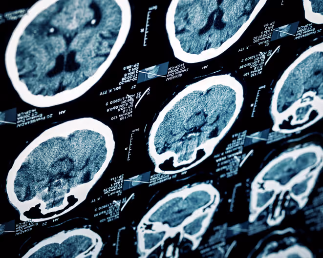 Brain injury dianosis
