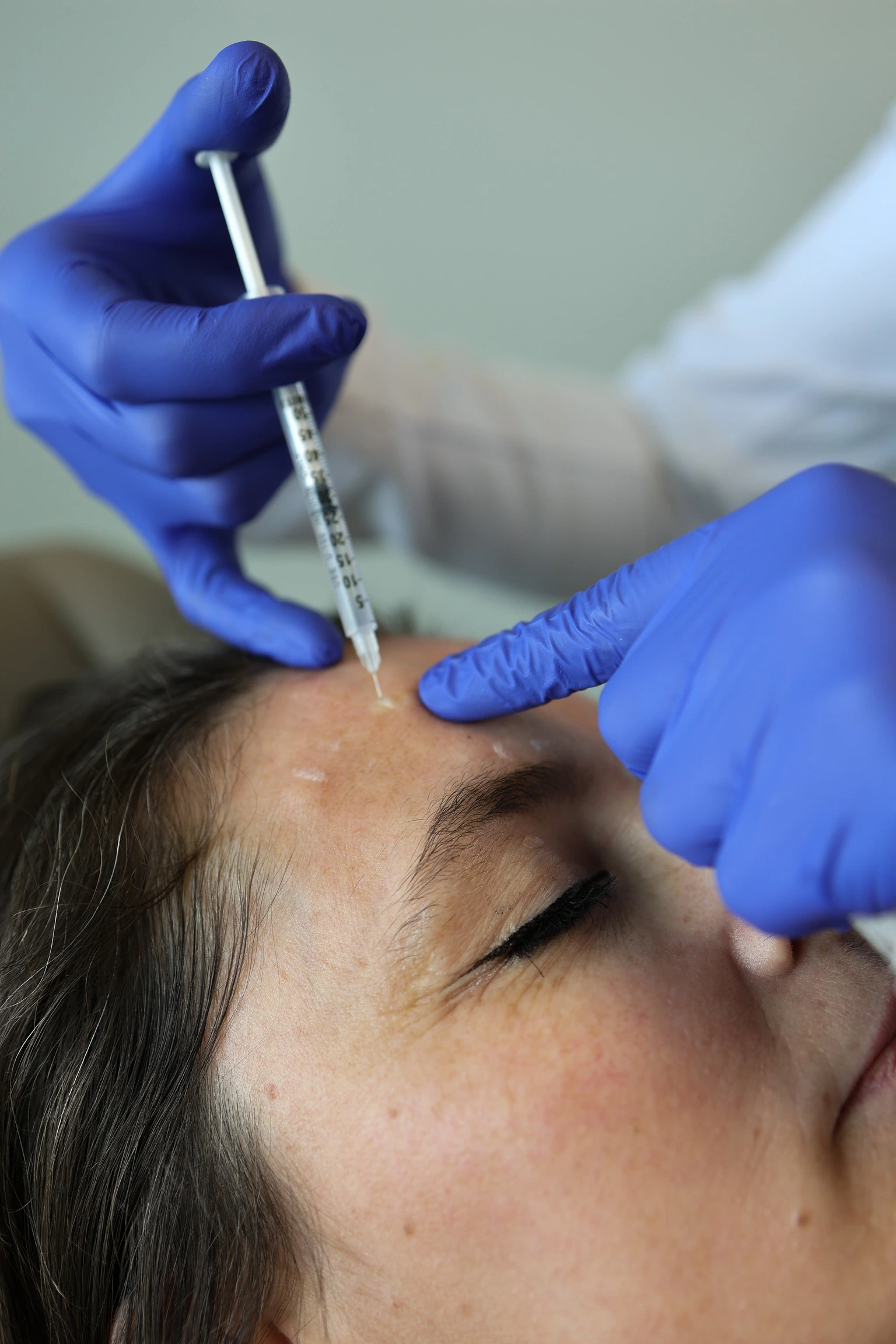 BOTOX® close-up of a patient receiving anti-wrinkle injections to her forehead, administered by a medical professional in blue gloves. at Becker Cosmetic in Enumclaw WA