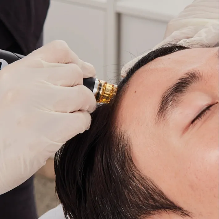 Close-up of a person receiving a hair restoration treatment on their scalp with a micro-needling device operated by a gloved hand. showing collagen induction results at Becker Cosmetic