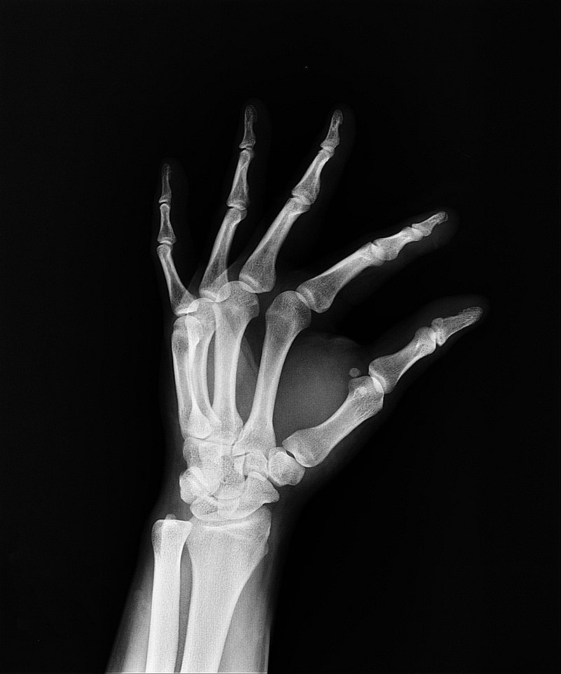 An X-ray image of a hand