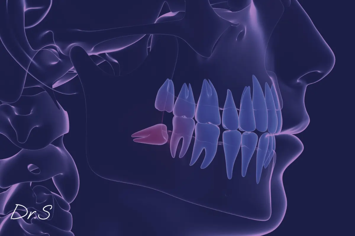 Pourquoi enlever les dents de sagesse ou les conserver ?