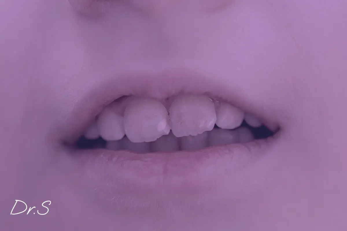 Gouttière pour le bruxisme : solution efficace pour les patients