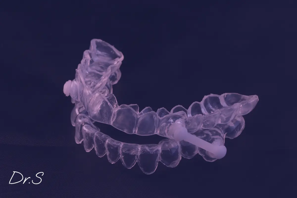 Orthèse avancée mandibulaire : solution efficace contre l’apnée du sommeil