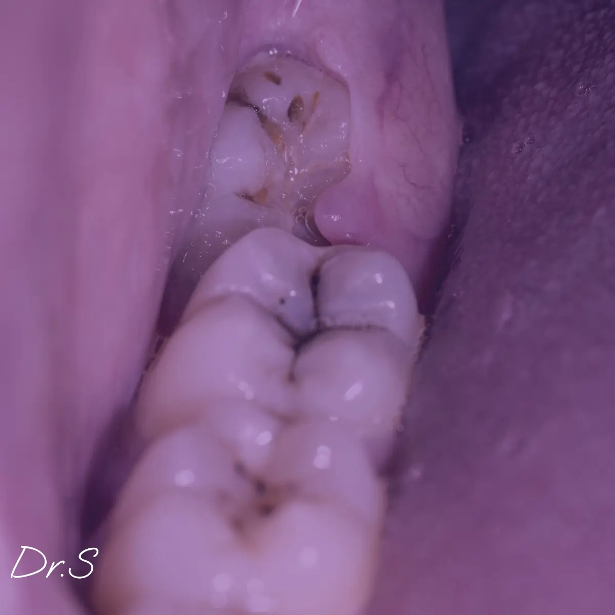 Dent de sagesse : taille, impact et extraction