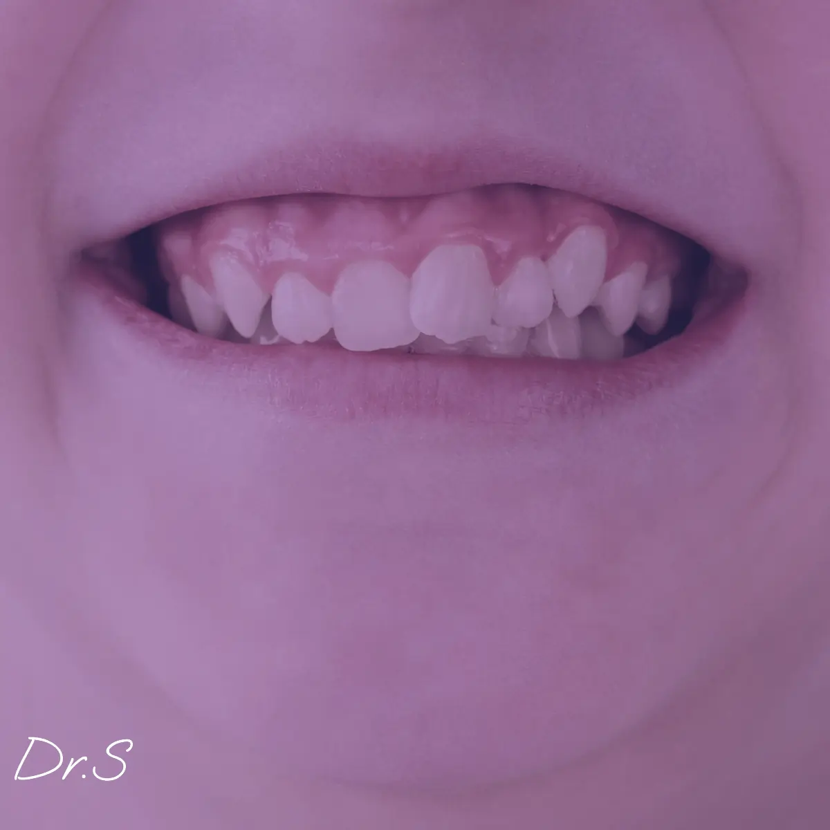 Dent de sagesse gonflée : que faire et quand s'inquiéter ?