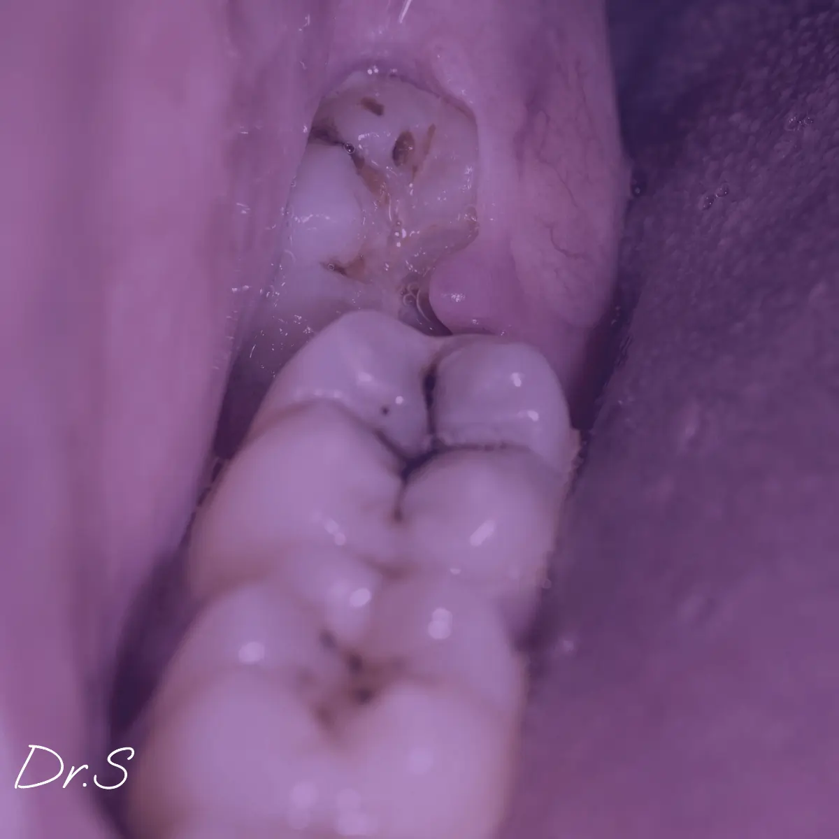 Comment traiter un abcès dent de sagesse efficacement