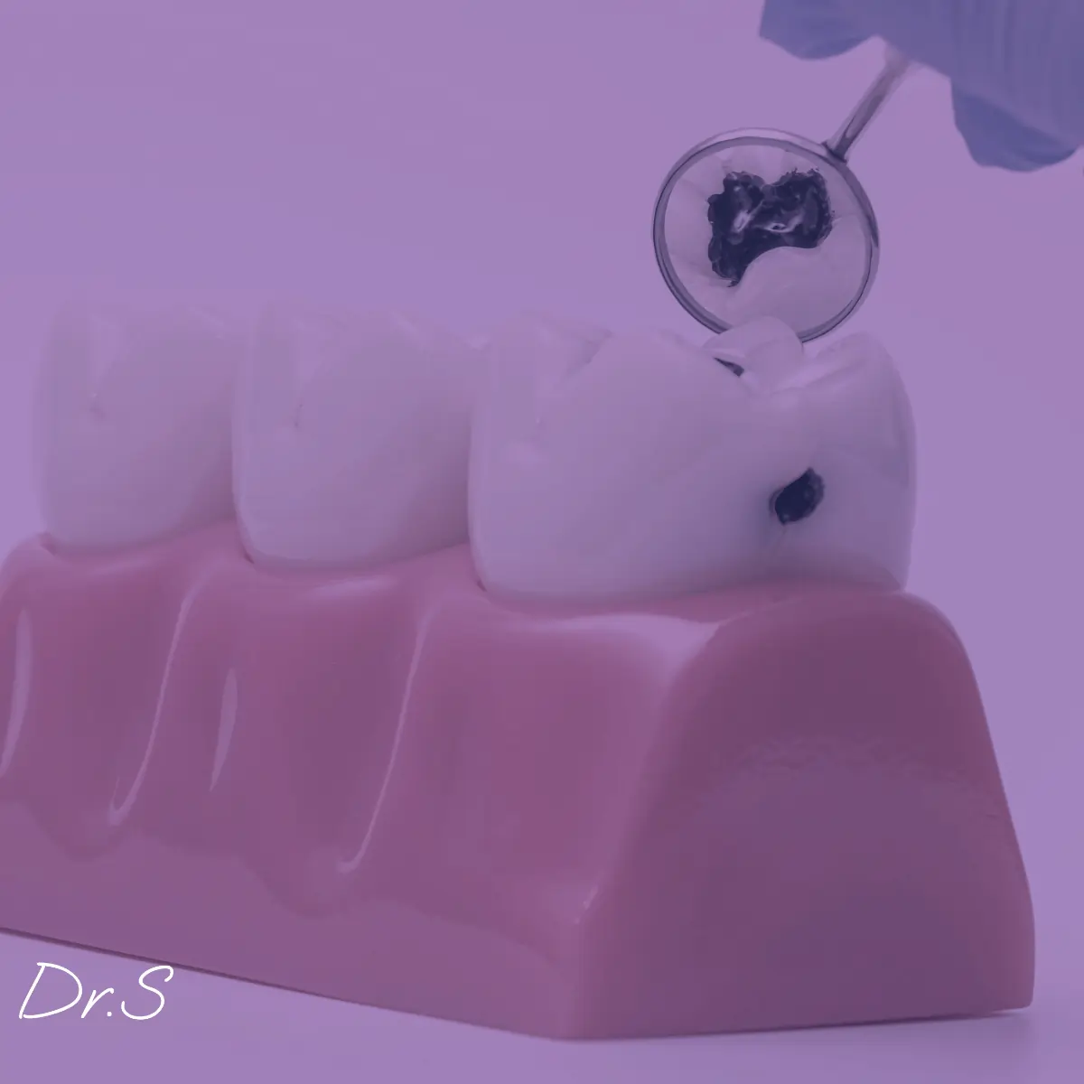 Comment traiter un abcès dent de sagesse efficacement