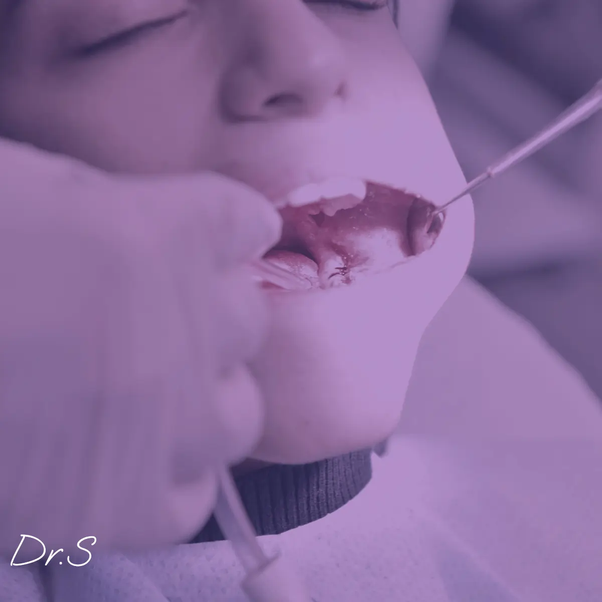 Comment traiter un abcès dent de sagesse efficacement