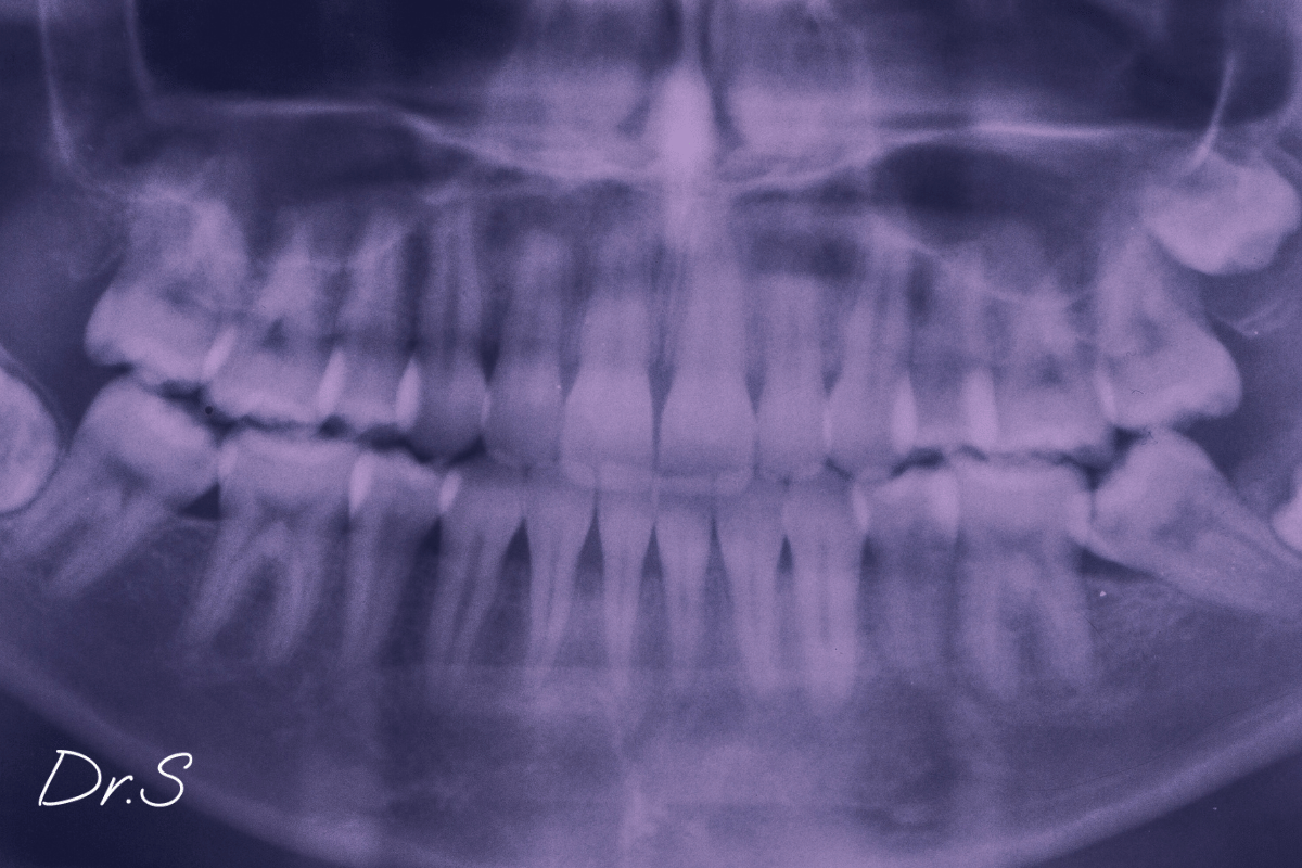 Cicatrisation d’une dent de sagesse : ce qu’il faut savoir
