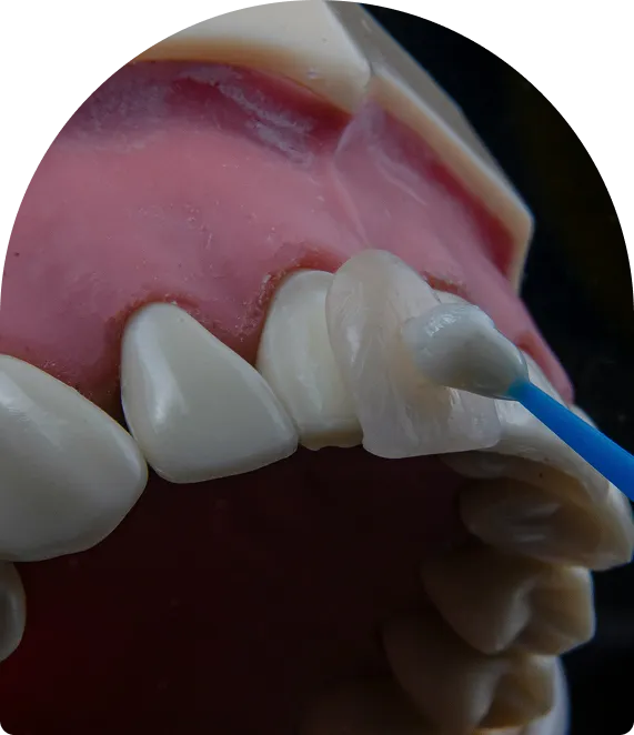 Inlays & Onlays near you