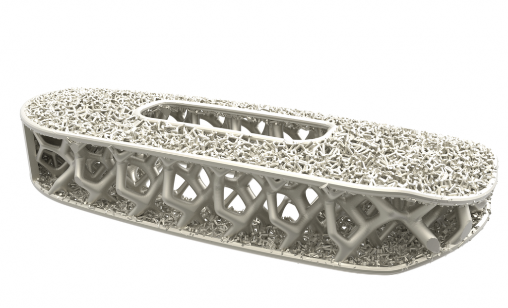 NuVasive titanium implant generative design