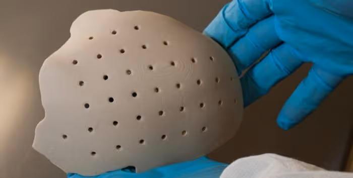 Ein OXPEKK SLS 3D gedrucktes Schädelimplantat [Bildnachweis: Oxford Performance Materials]