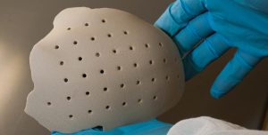 An OXPEKK SLS 3D printed cranial implant [Image credit: Oxford Performance Materials]