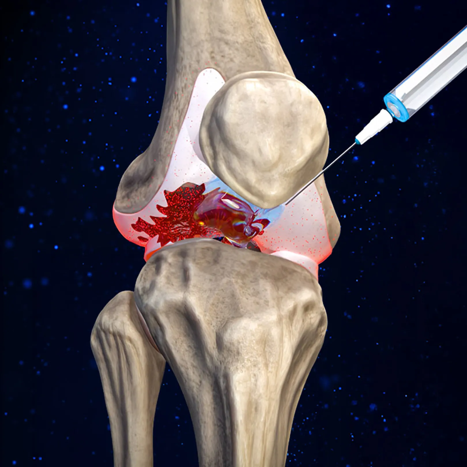 3D knee joint model receiving a therapeutic injection into red inflamed cartilage with dark blue background