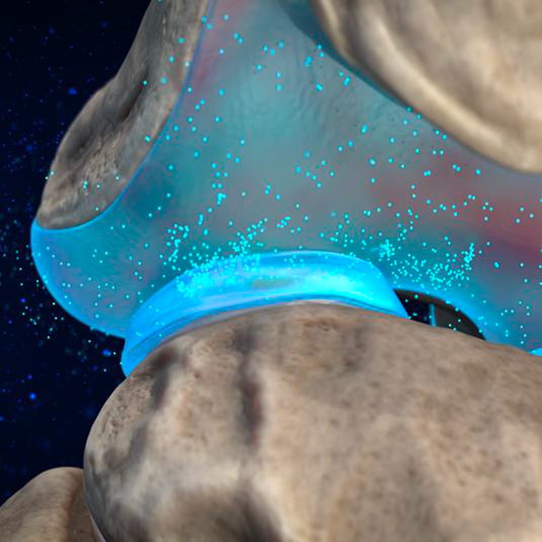 3D close-up of knee joint cartilage with therapeutic particles dispersing between bone surfaces